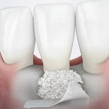 periodontal treatment 1